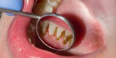 جير الاسنان ورائحة الفم الكريهة.. المخاطر والعلاج