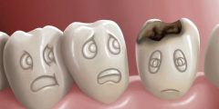 تسوس الأسنان | تعرف على الأسباب والأنواع والعِلاج
