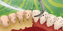 ازالة جير الاسنان ليست رفاهية.. أهمية إزالة الجير
