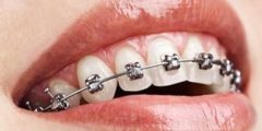 تقويم الاسنان.. تعرف على الأنواع والمميزات والتكلفة