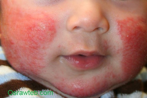 التهاب الجلد التأتبي عند الرضع