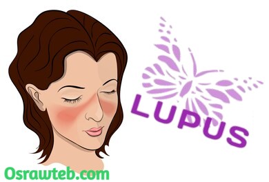 مرض lupus