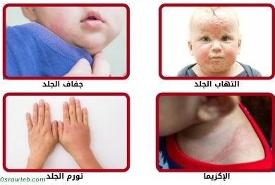 حساسية الجلد عند الاطفال من الاكل