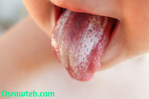 تبحث عن علاج فطريات الفم بالاعشاب؟!