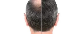 زراعة الشعر بتقنية 3d | شعر كثيف وأكثر ثباتًا